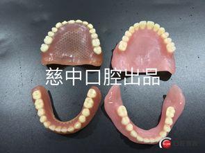 义齿安装视频,从准备到完成